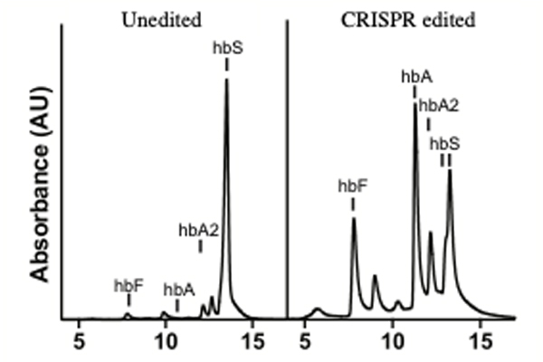 Editing of sickle hematopoetic stem/progenitor cells reduces sickle (hbS) and increases normal (hbA) hemoglobin.