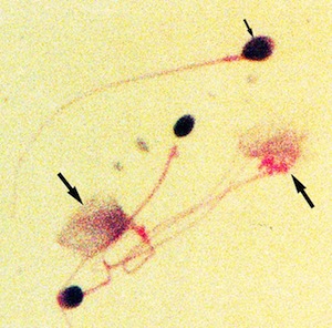 Human sperm undergoing slight and severe chromatin decondensation