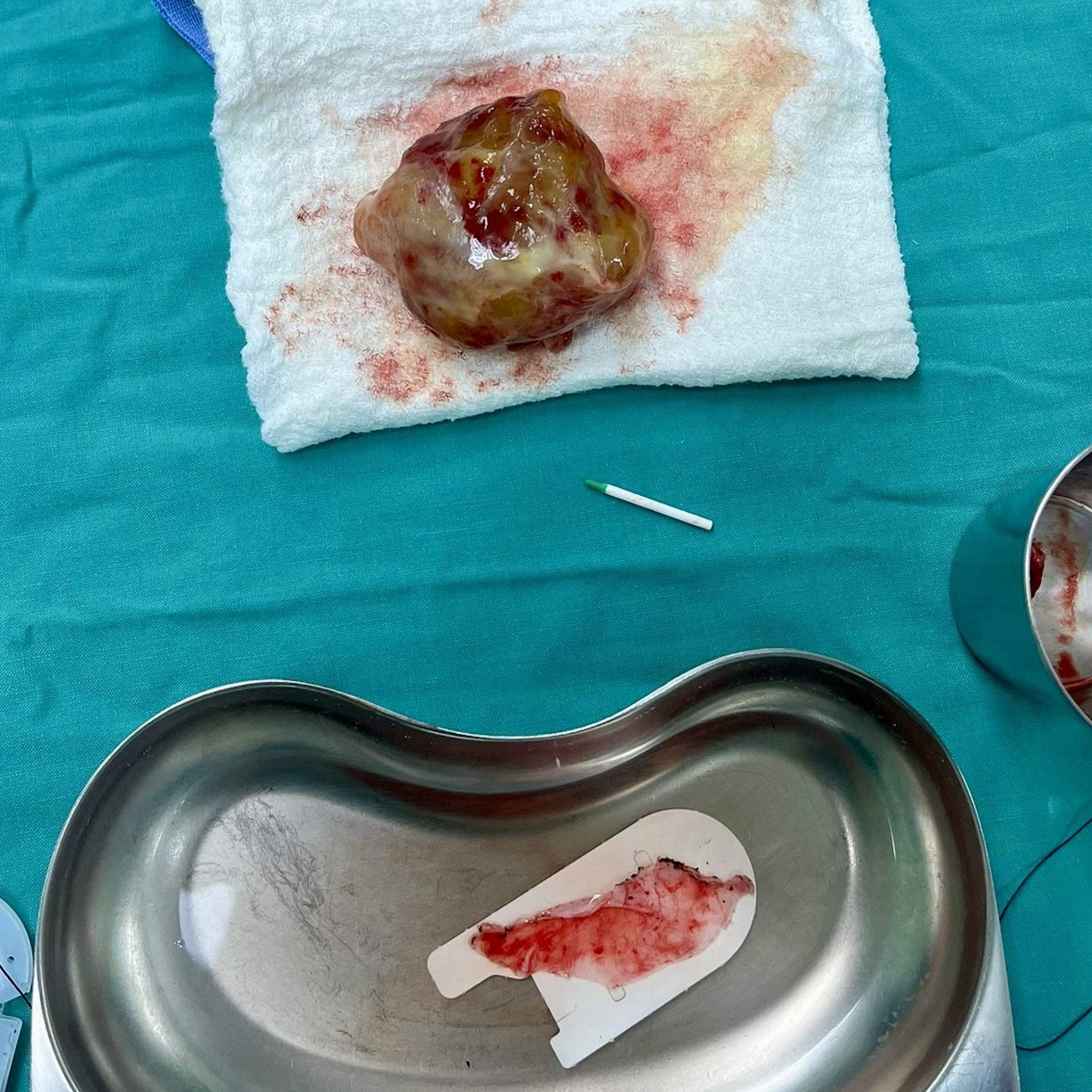 CT Mass