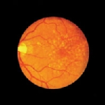 Retinal image of a patient with Stargardt macular dystrophy