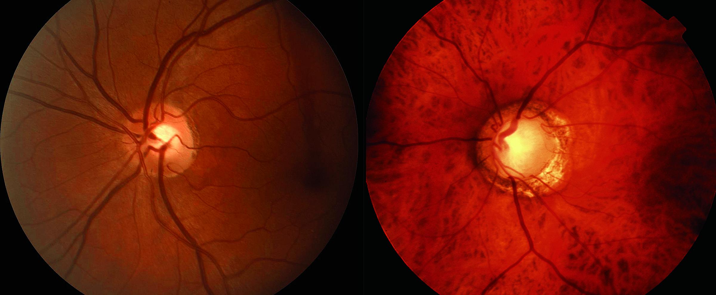 A healthy optic nerve, left, and one damaged by glaucoma.