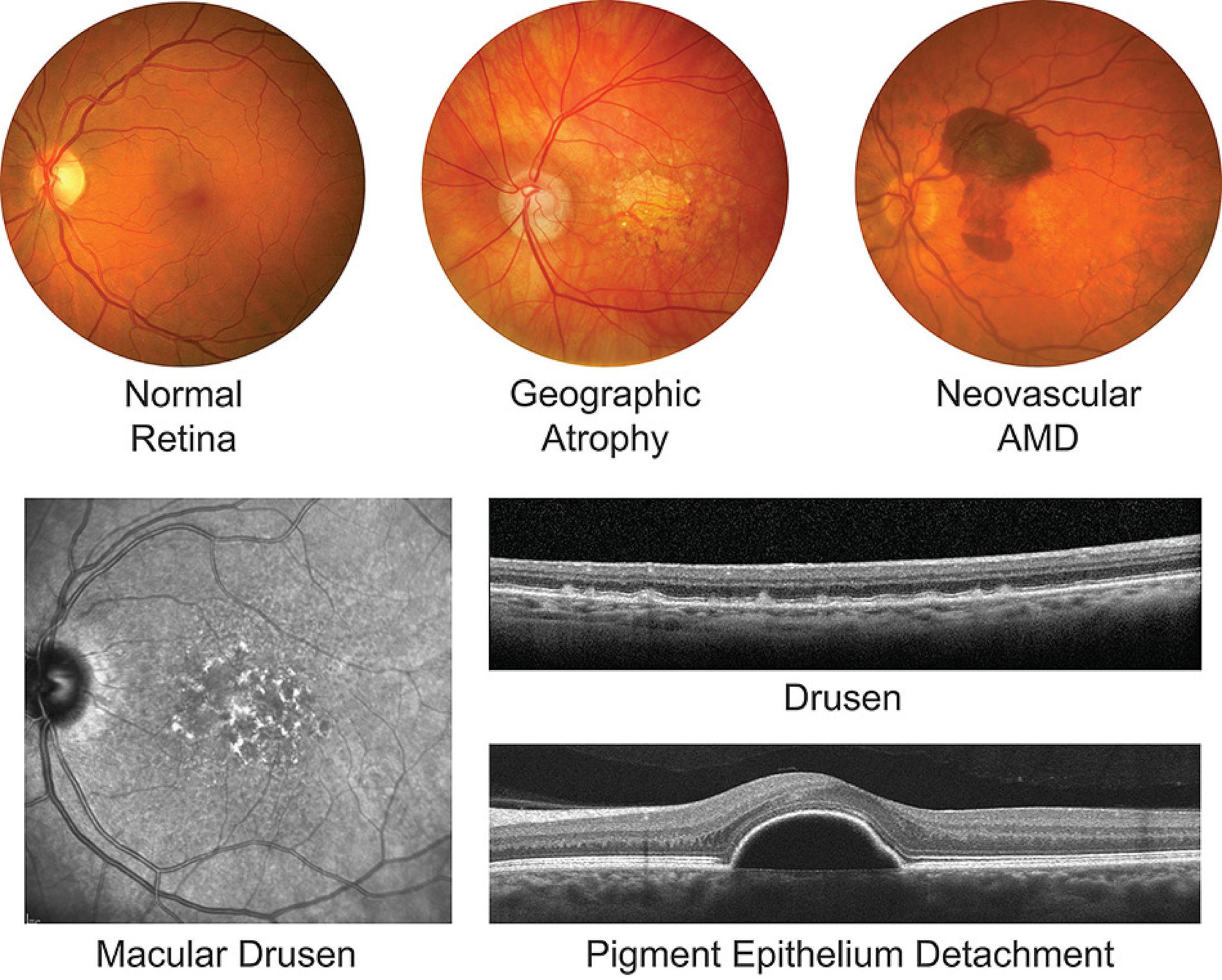 Stages of AMD.