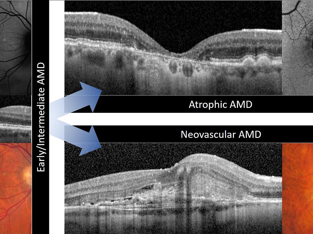 AMD disease progression research imaging.