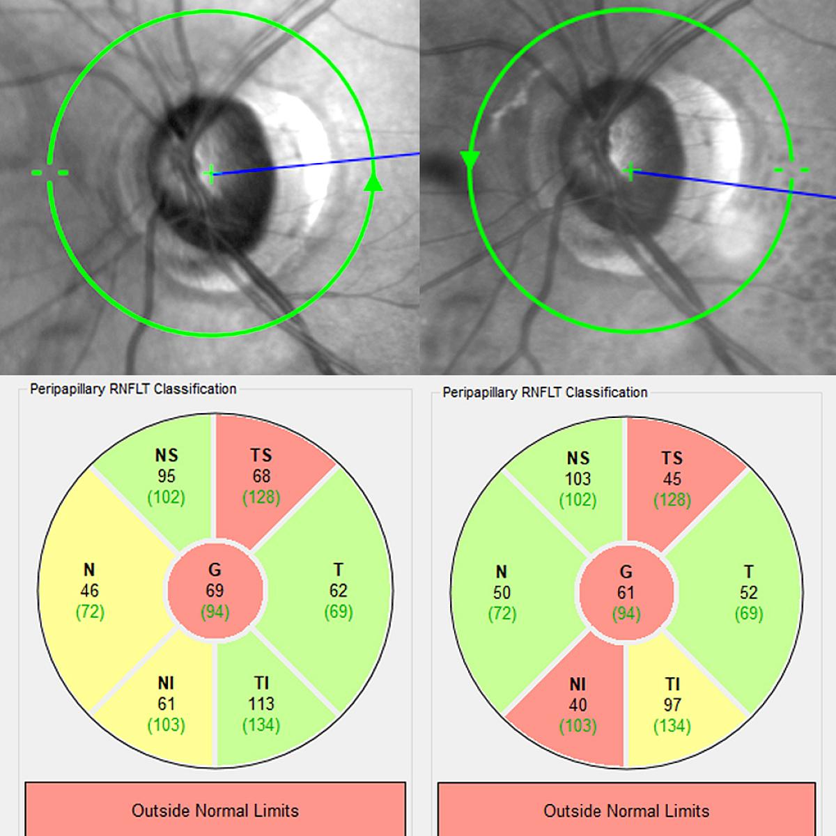 UREAD imaging showing progression of glaucoma.