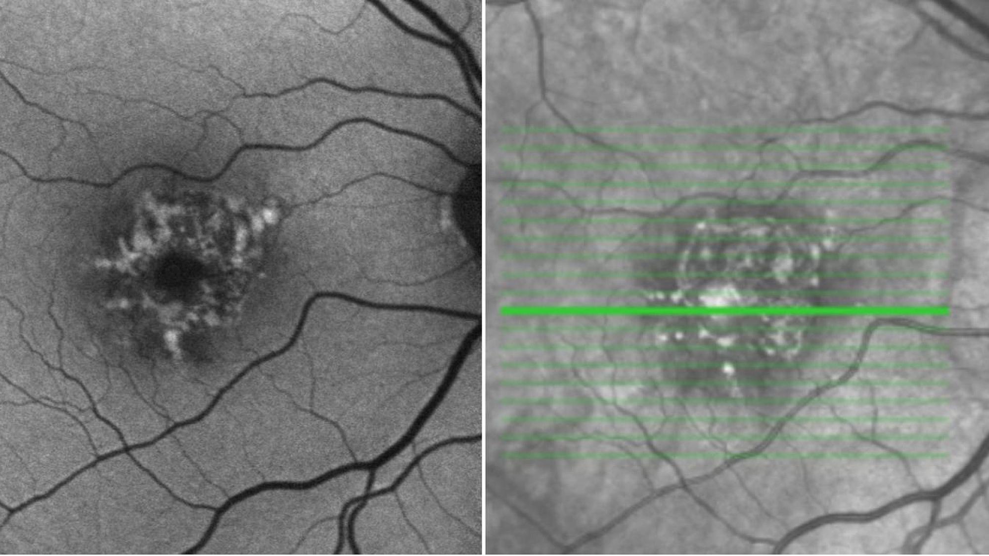 Ophthalmic imaging of "dry" AMD.