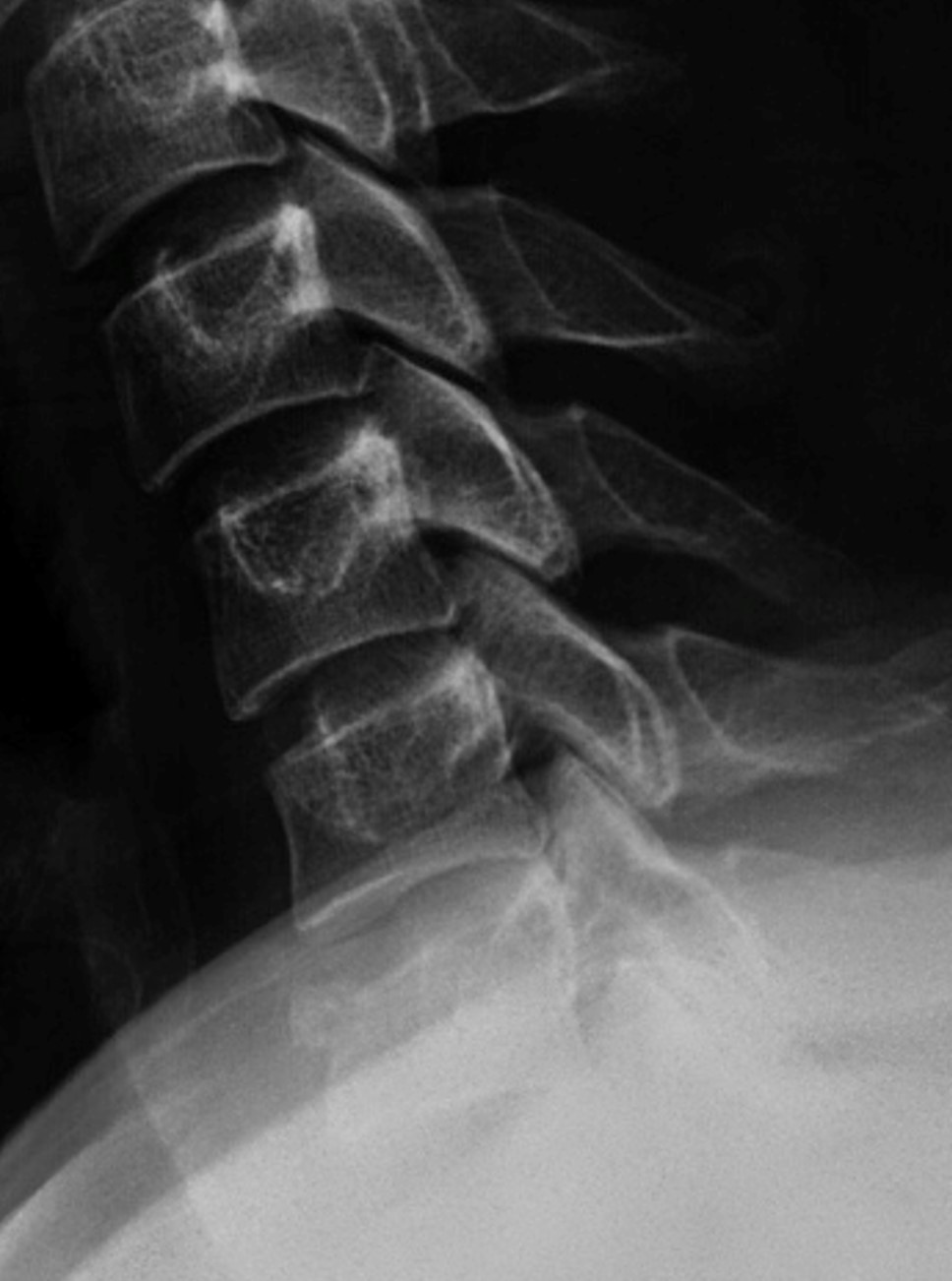 Cervical Spine trauma