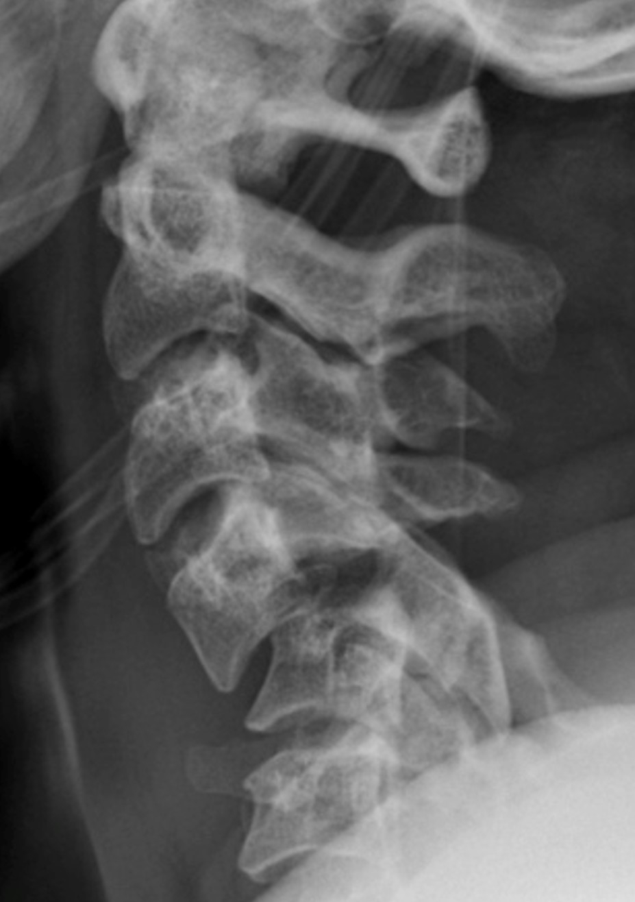 Cervical Spine Trauma