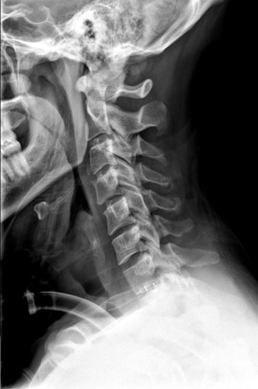 Cervical Spine Trauma | Radiology | U of U School of Medicine