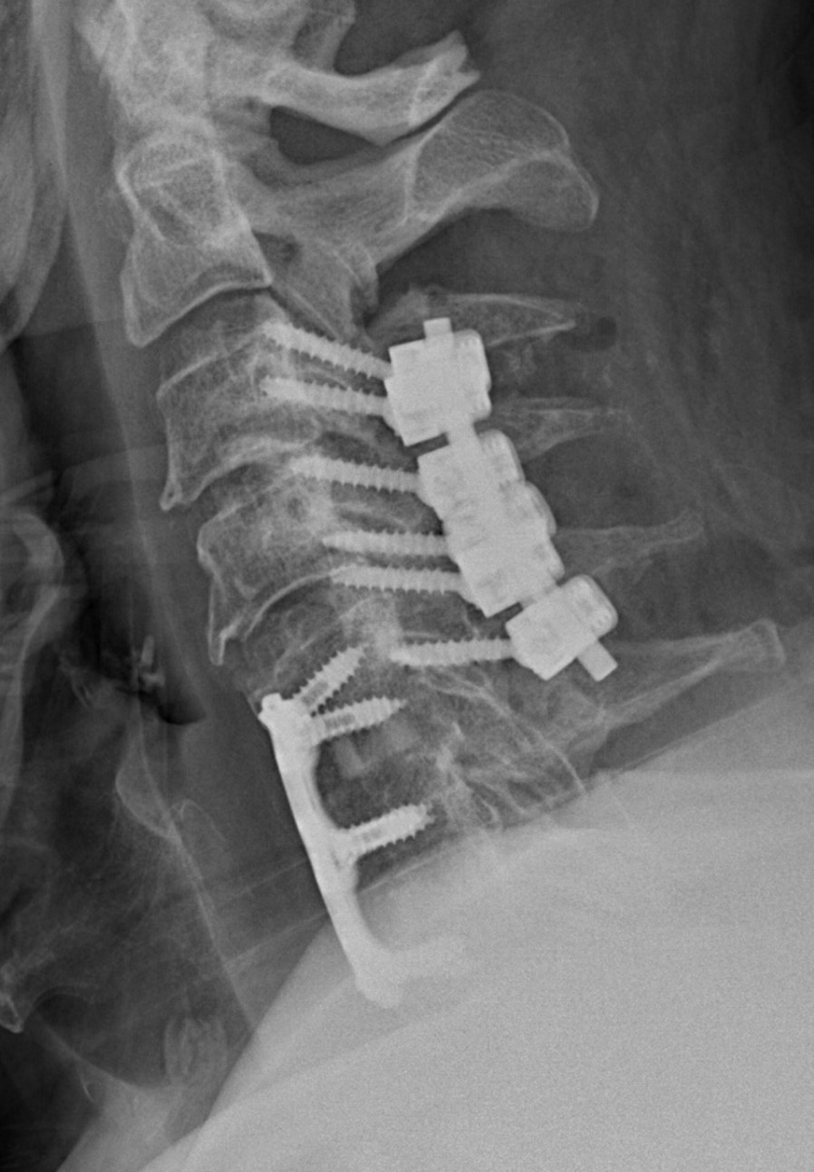 Cervical Spine post-op