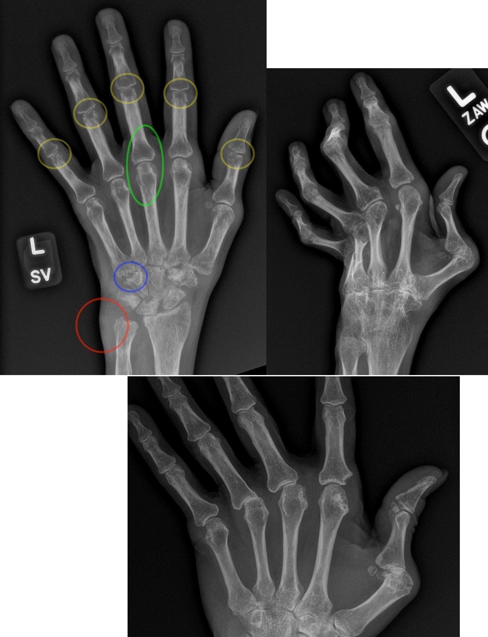 Hand Arthropathy