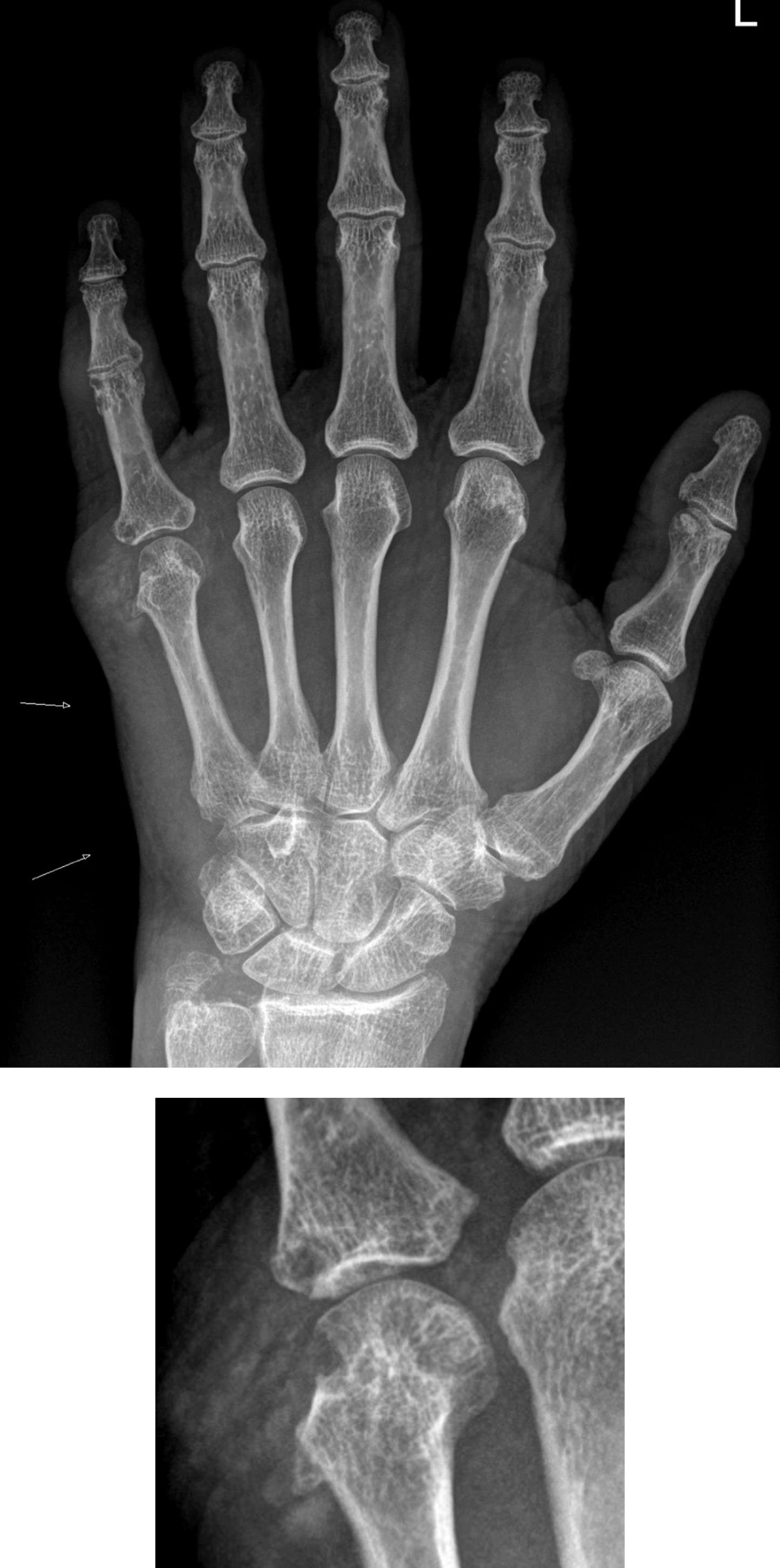 Hand Arthropathy