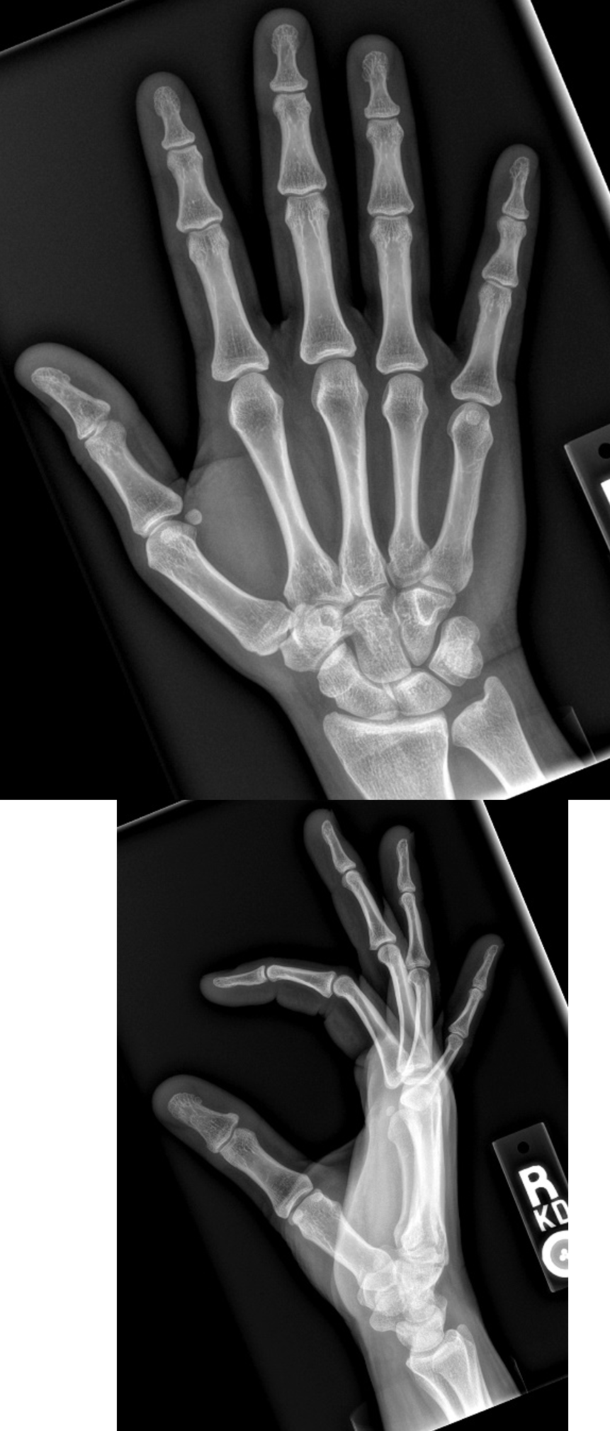 Hand Trauma
