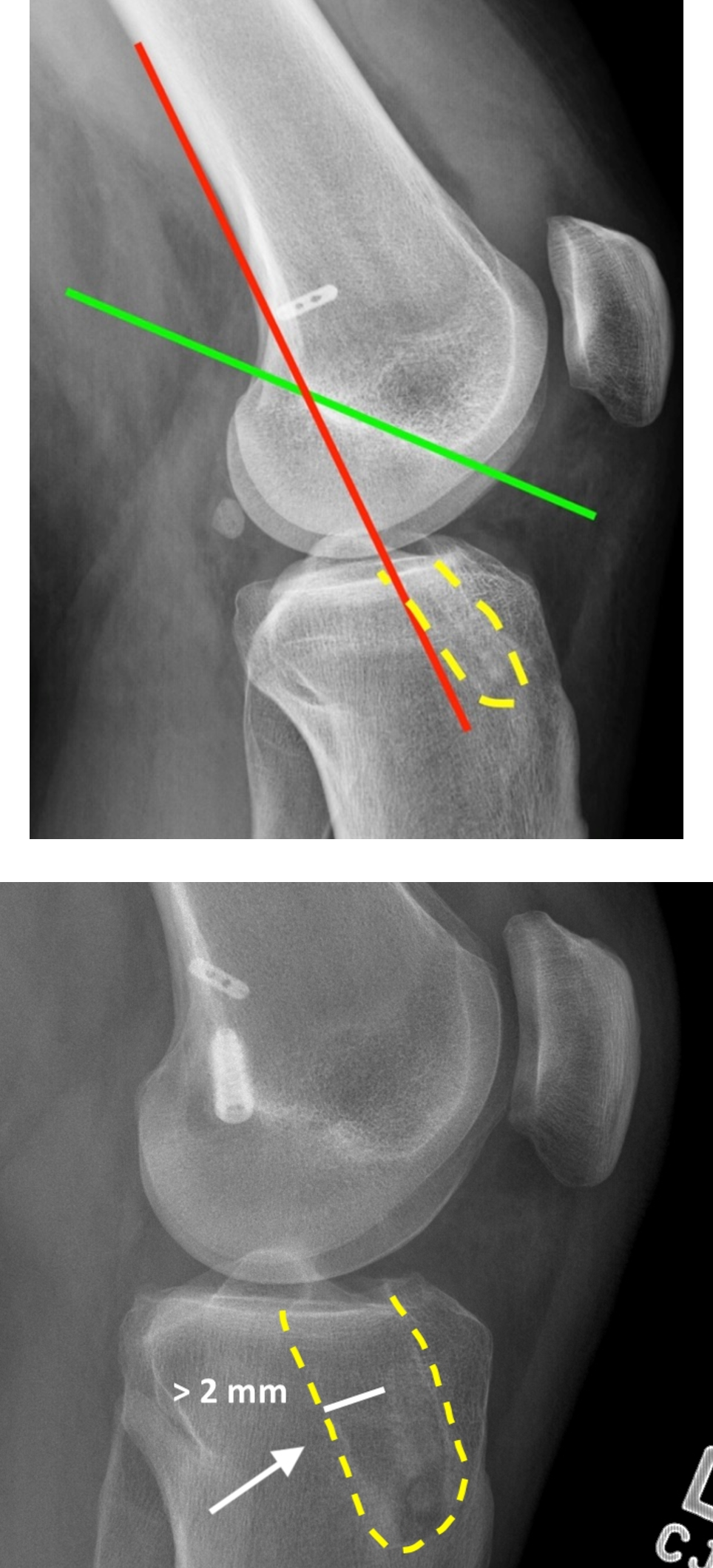 Postoperative Knee 2