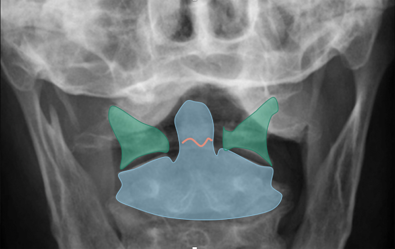 Cervical Spine 2.2