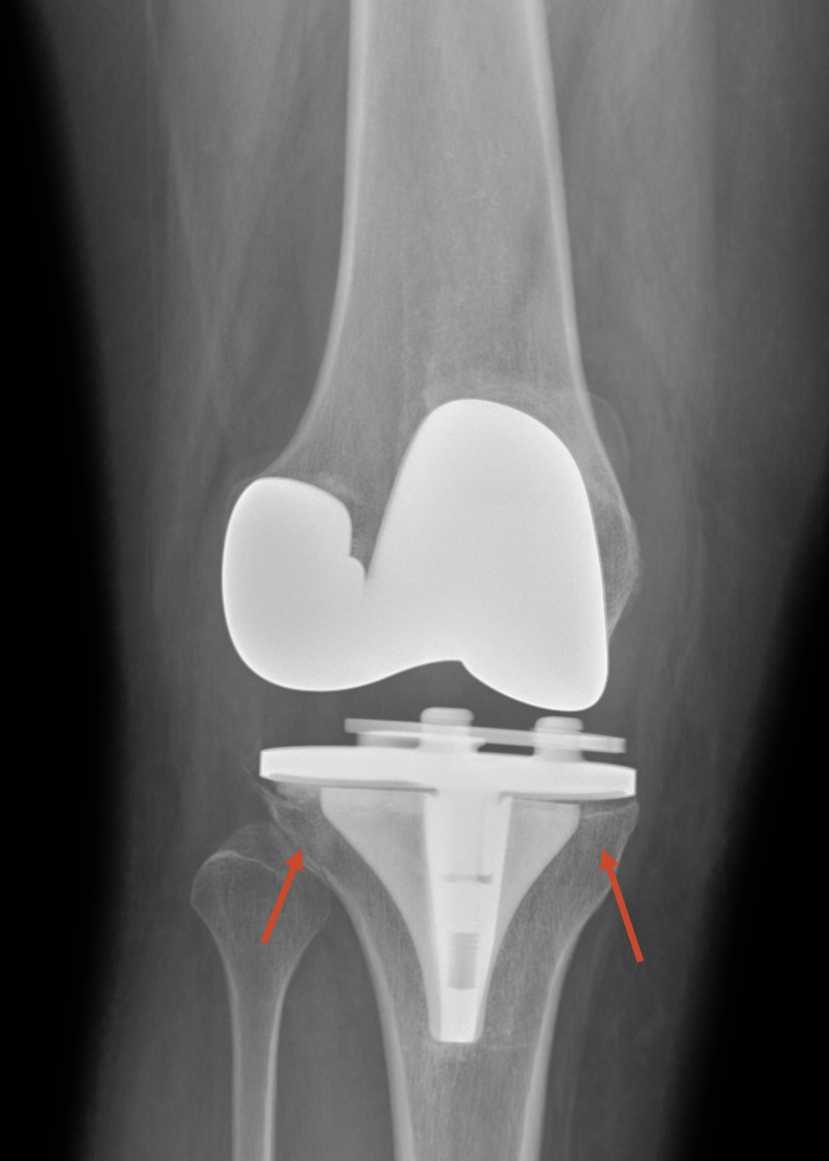 Postoperative Knee 3