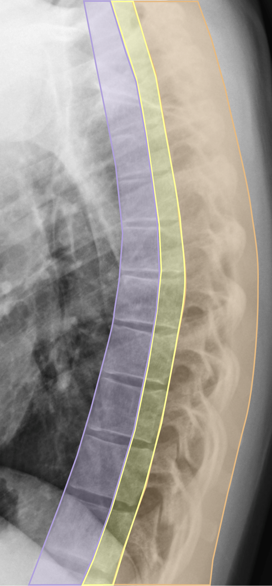 Thoracic spine Trauma 1