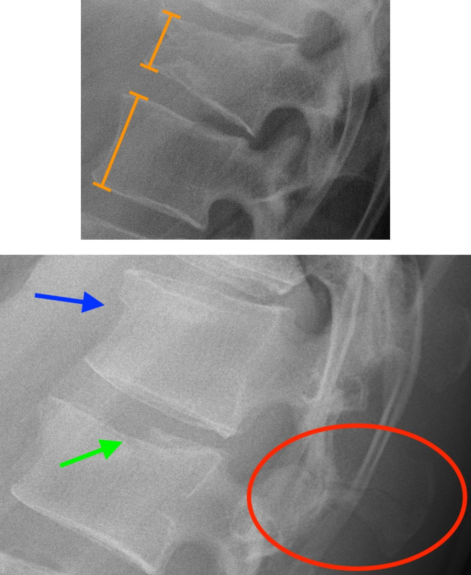 Thoracic spine Trauma 2