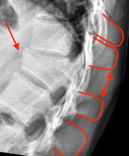 Thoracic spine Trauma 3