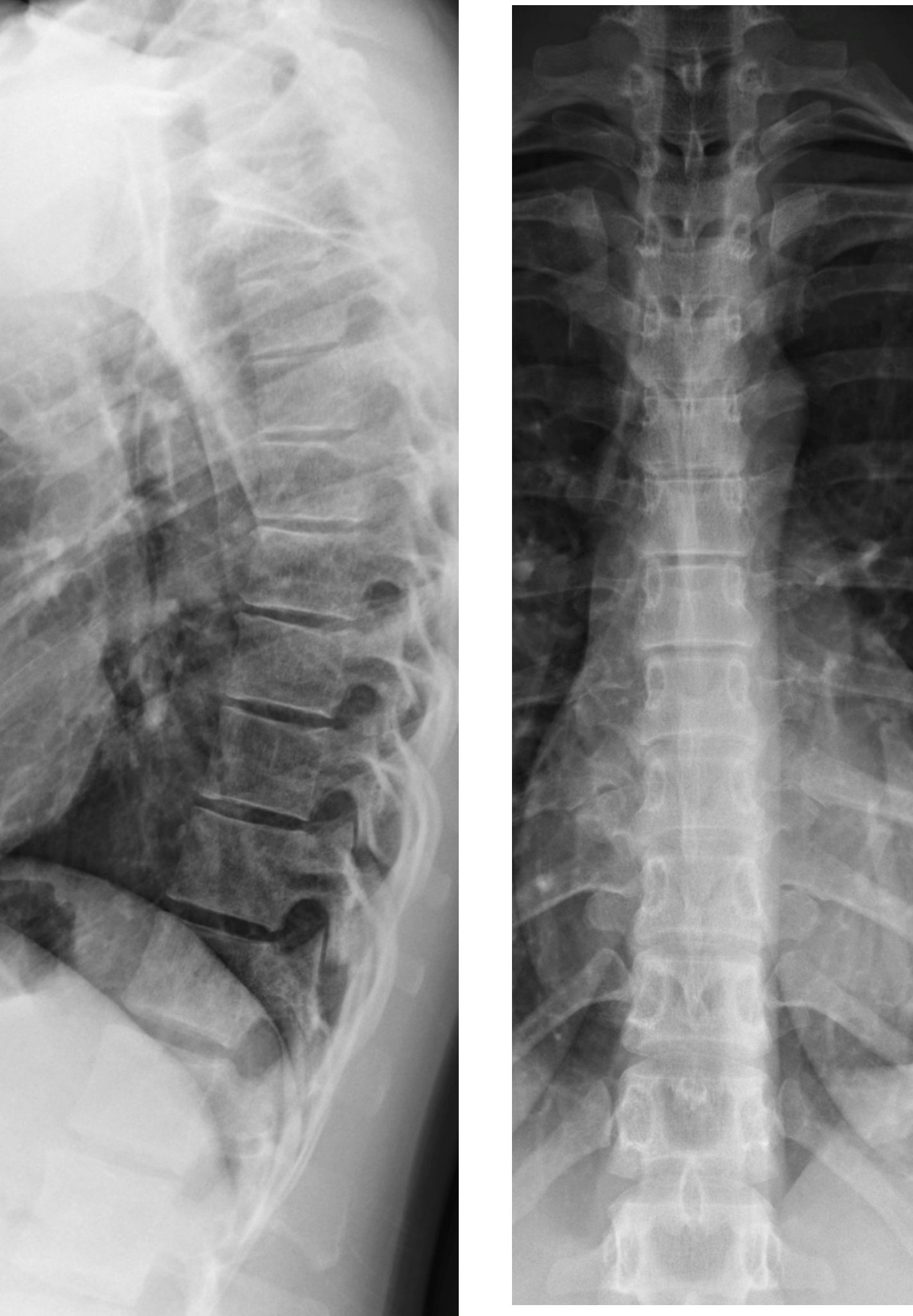 Thoracic spine Trauma 4