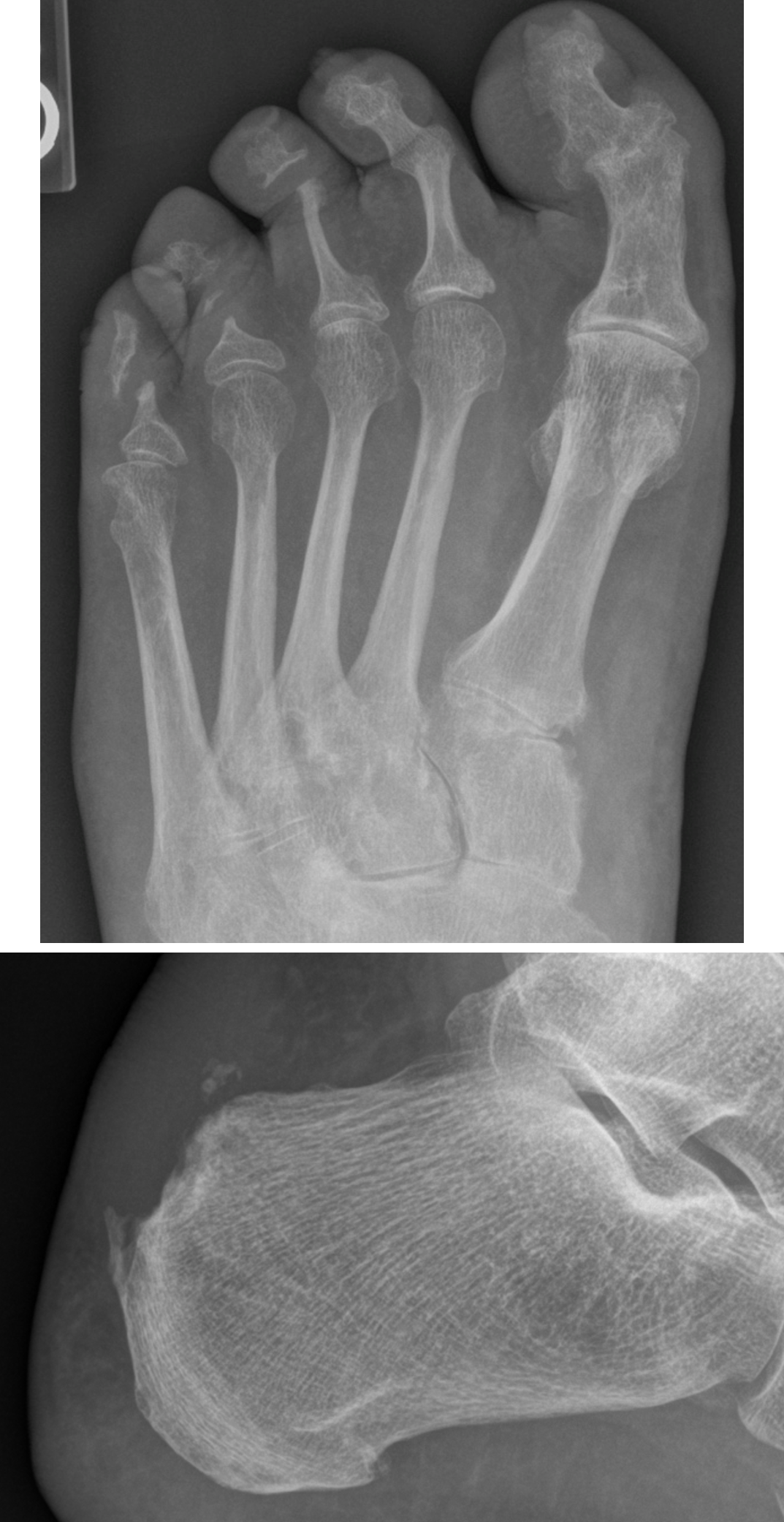 Foot Inflammatory Arthritis 2