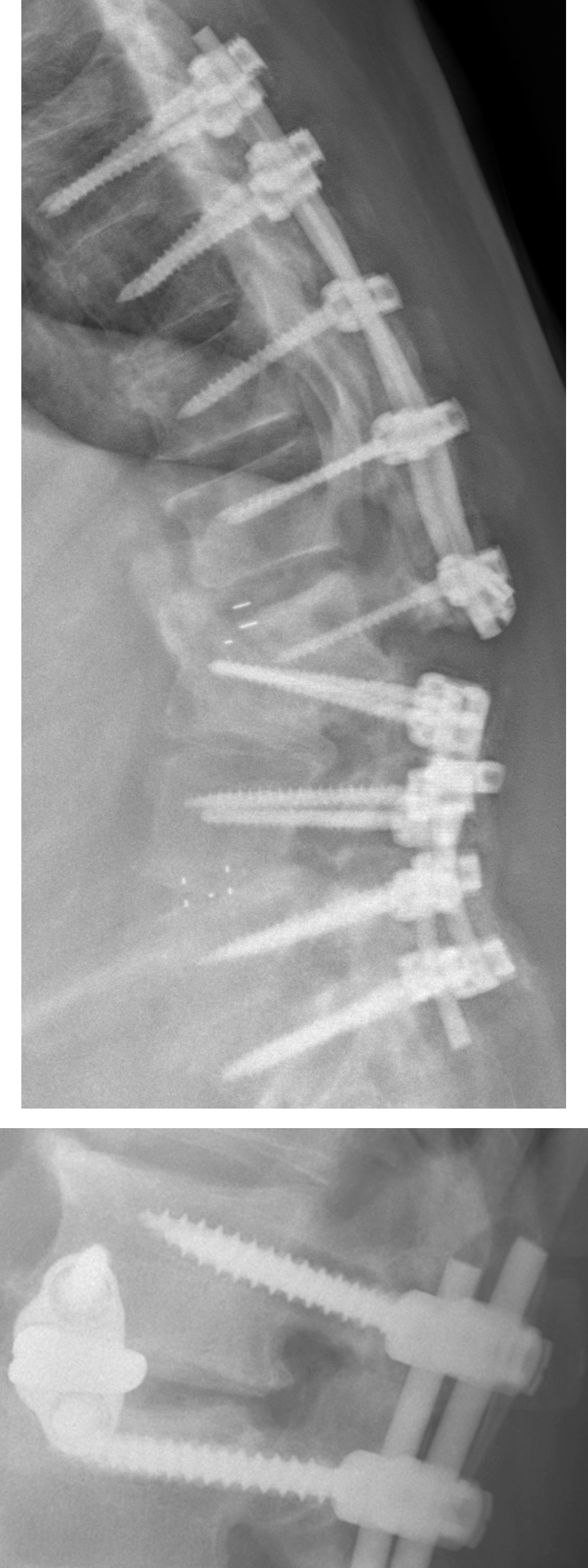 Postoperative Lumbar Spine