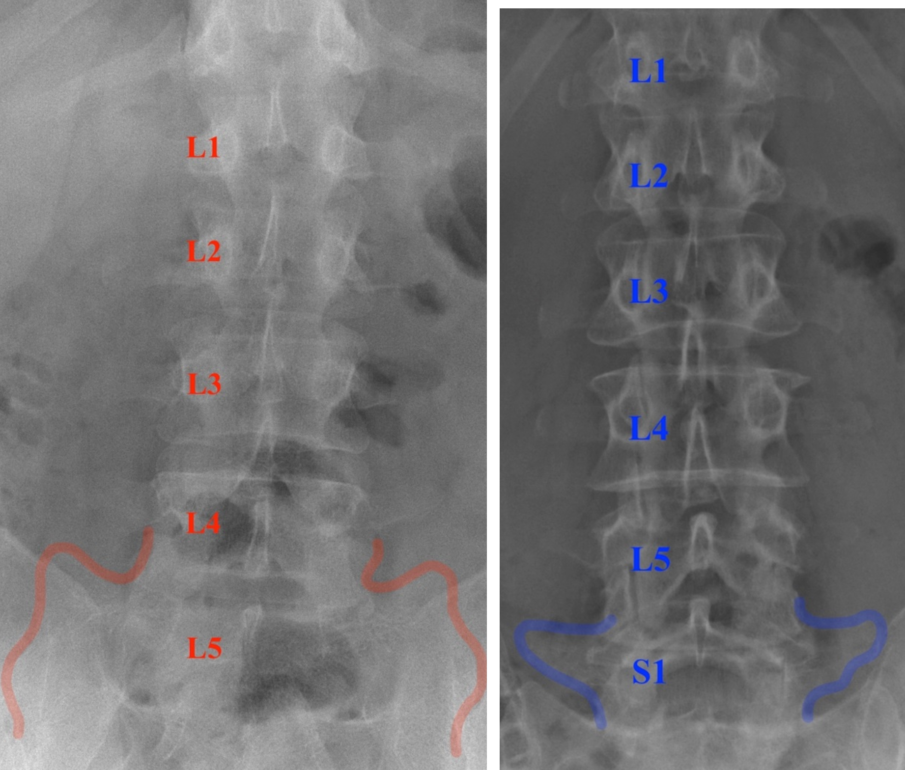 lspinetrauma1