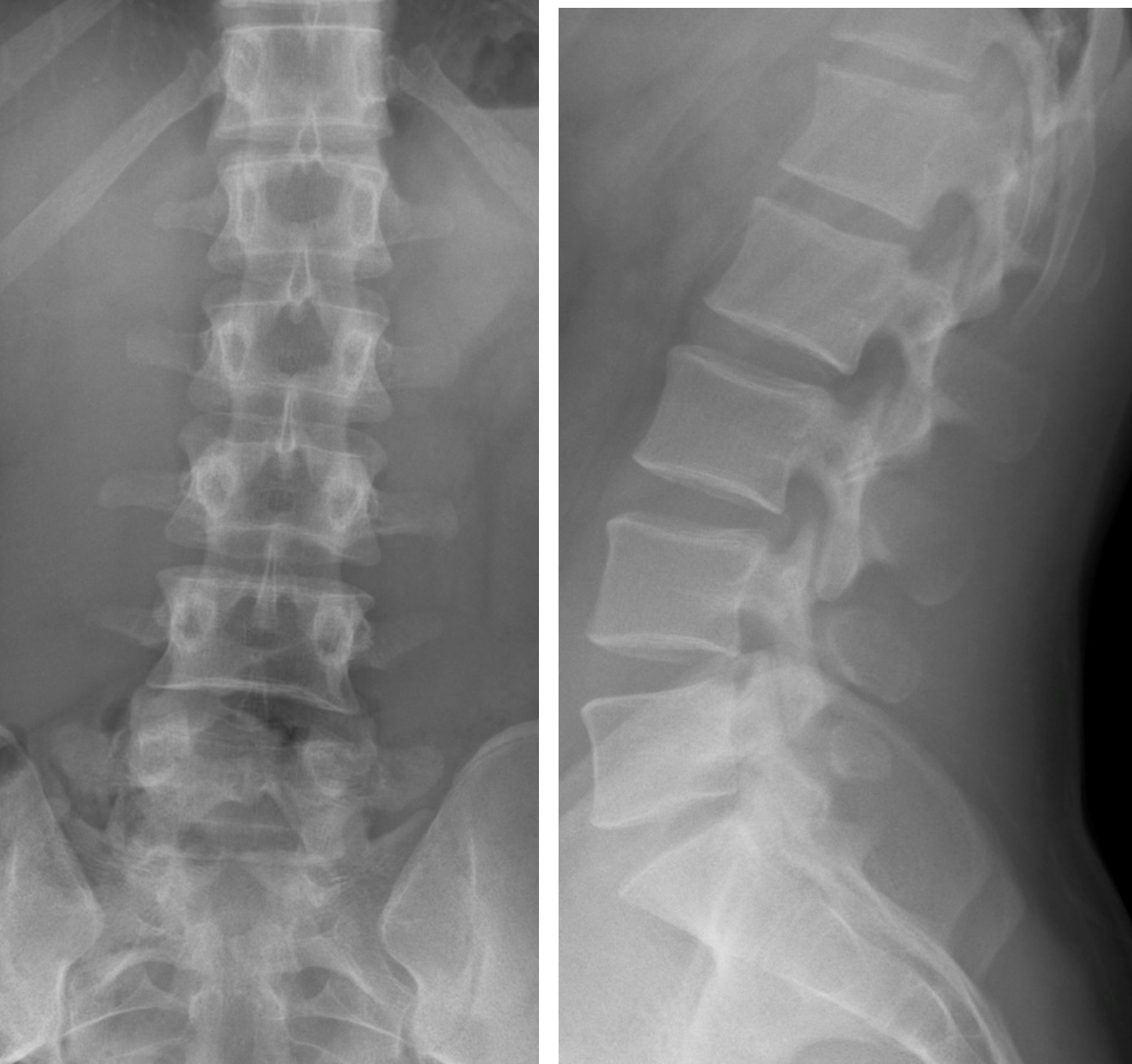 Lumbar Spine Trauma Radiology U Of U School Of Medicine
