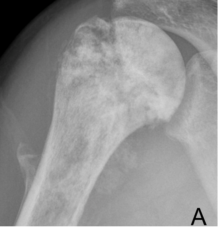 Tumor Bone Lesion 11a