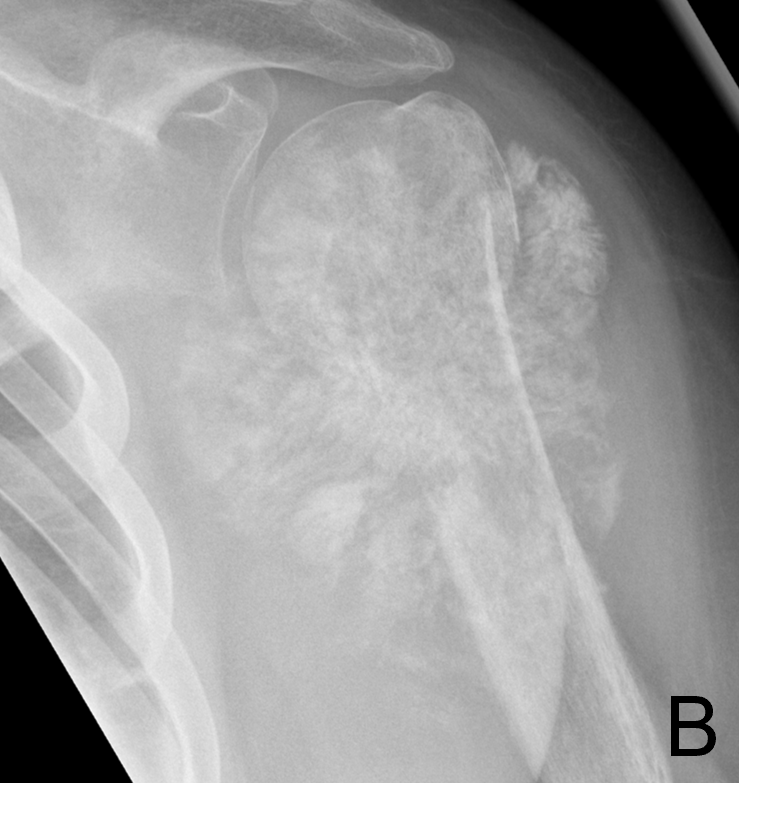 Tumor Bone Lesion 11b