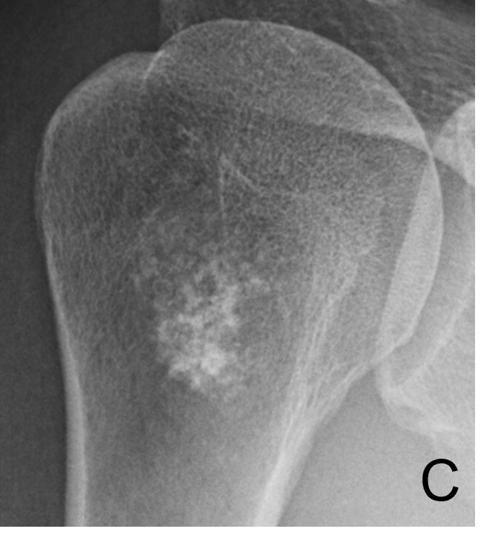 Tumor Bone Lesion 11c