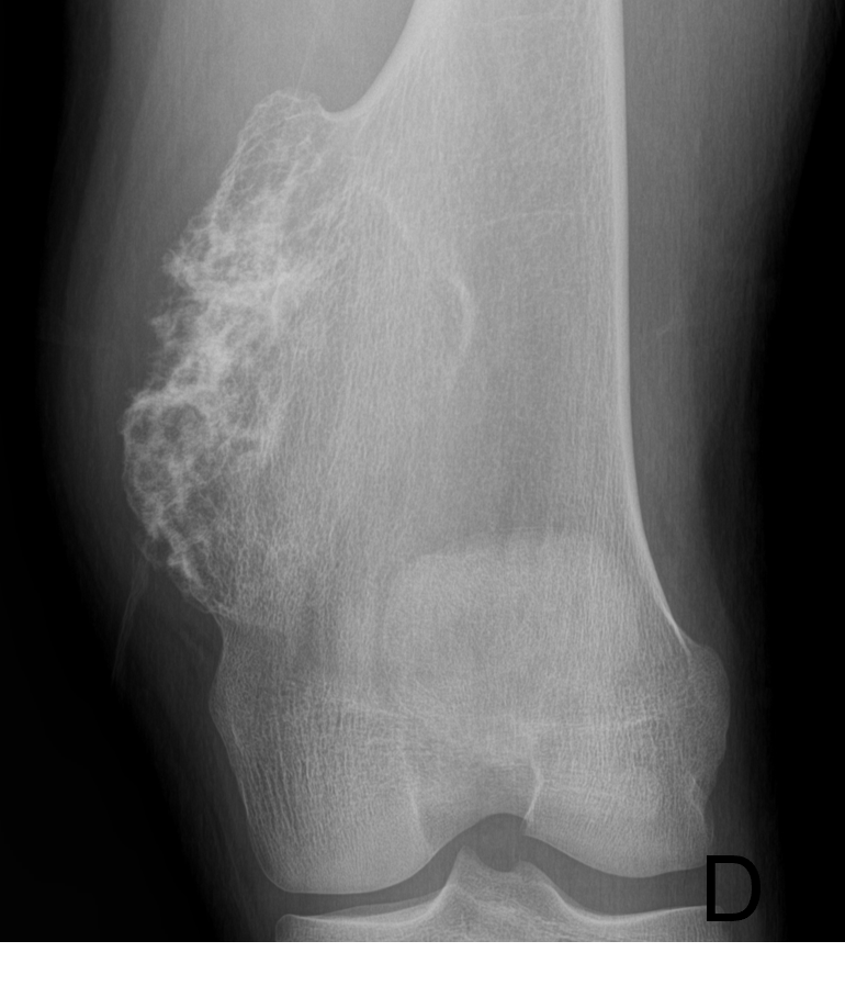 Tumor Bone Lesion 11d