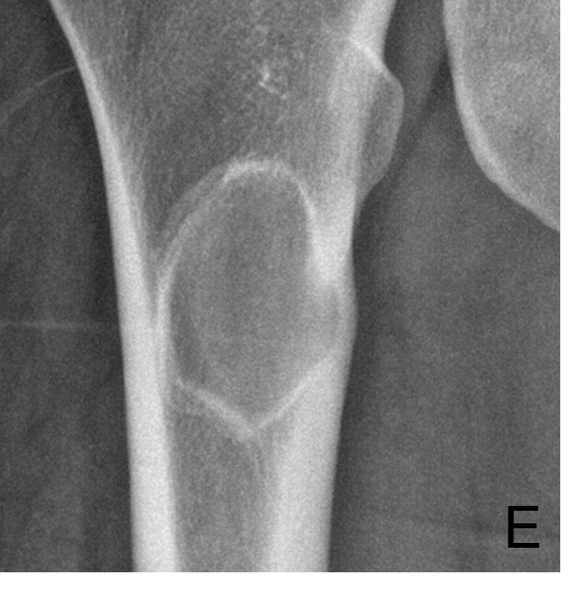 Tumor Bone Lesion 11e