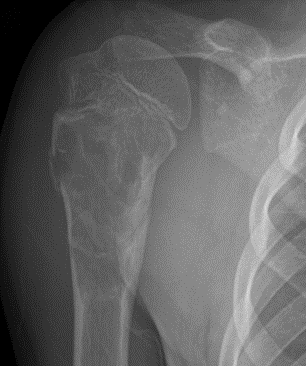 Tumor Bone Lesion 13b