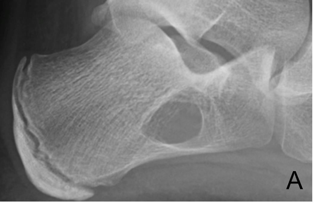 Tumor Bone Lesion 6a