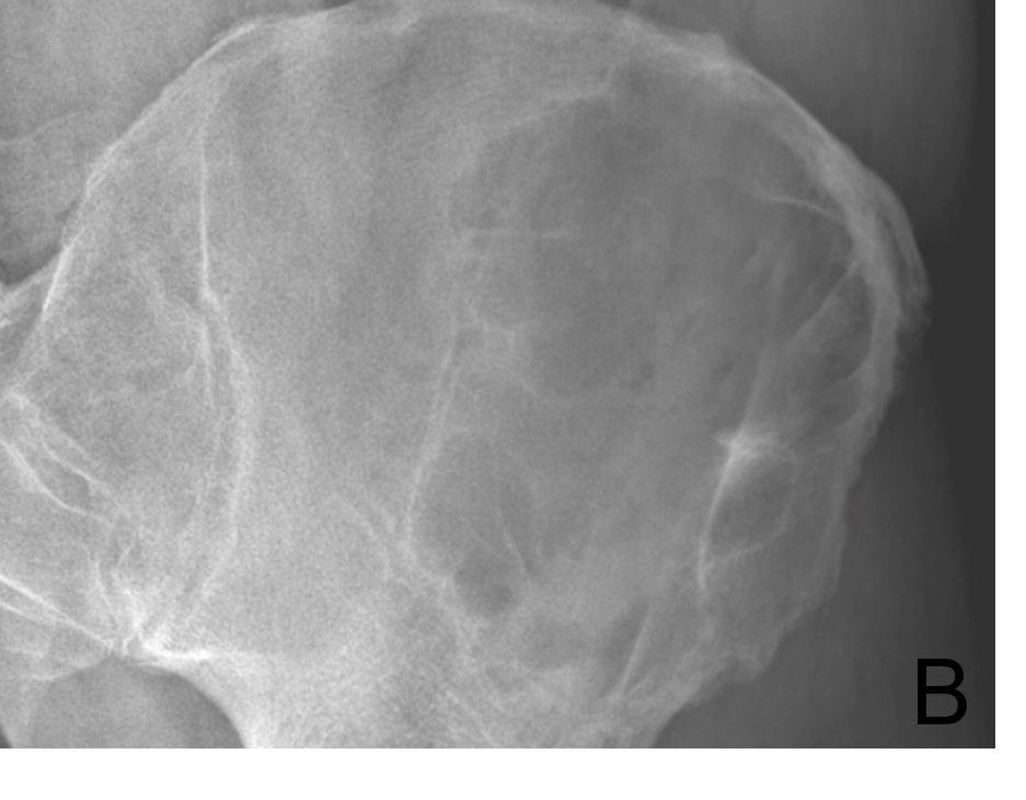 Tumor Bone Lesion 6b