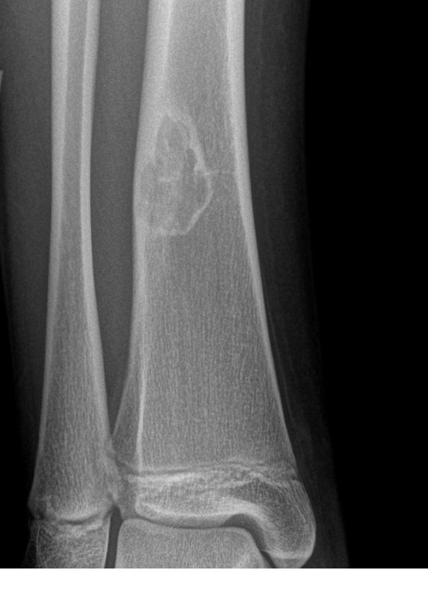 Tumor Bone Lesion 6c