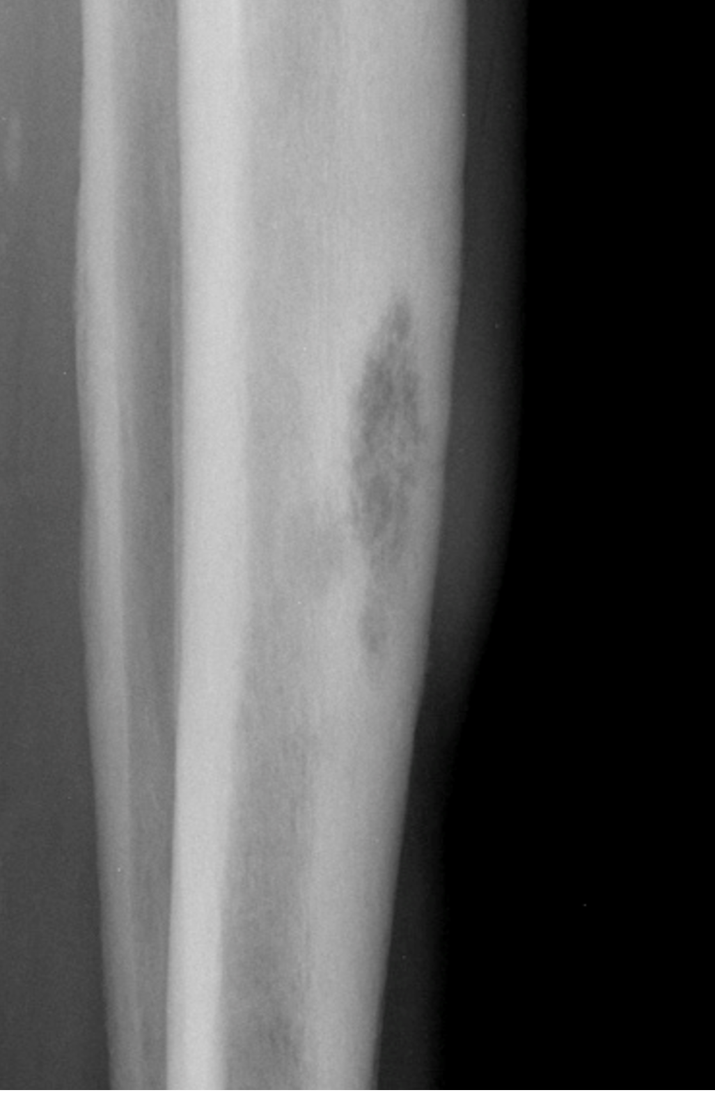 Tumor Bone Lesion 6e