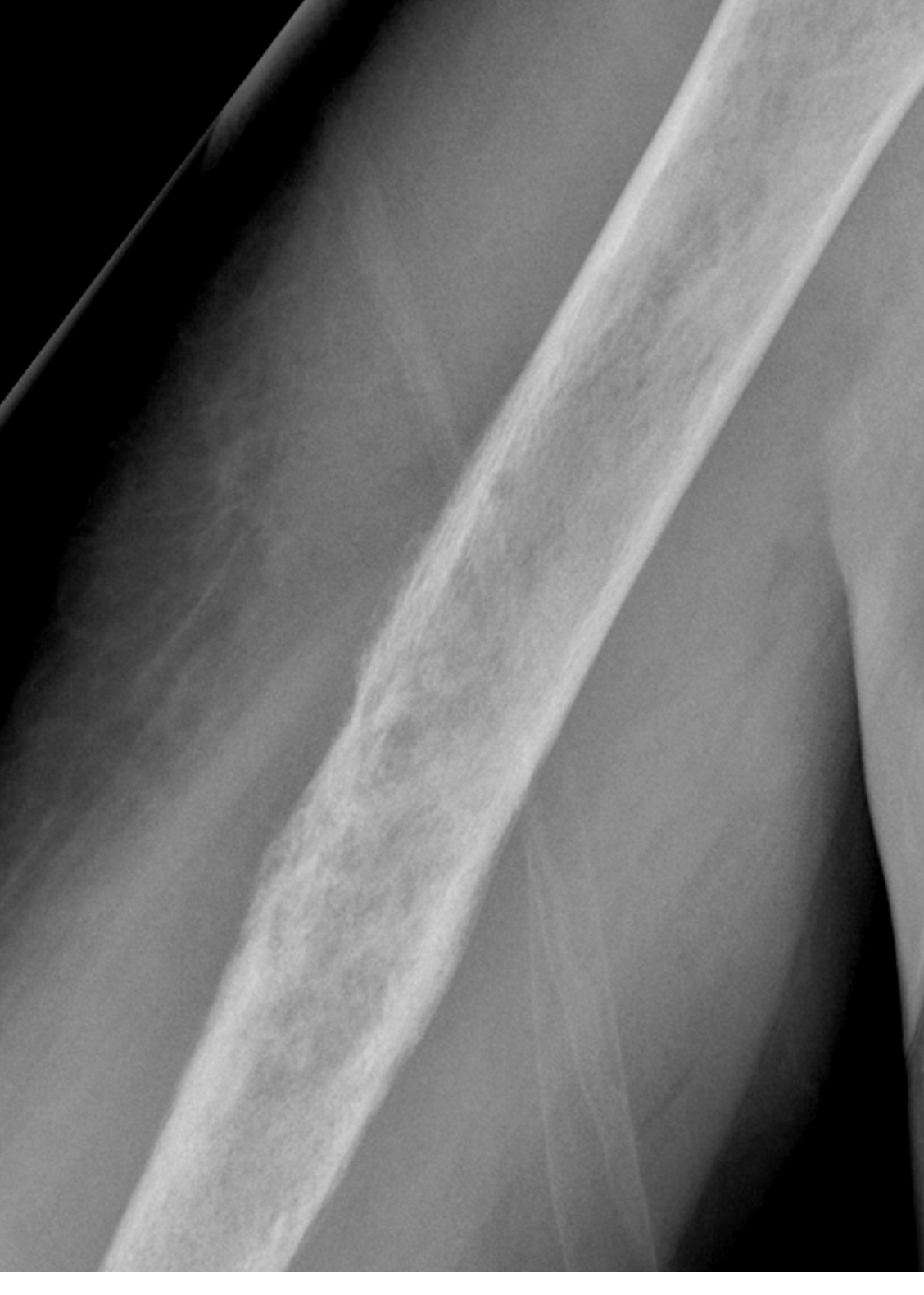 Tumor Bone Lesion 6f