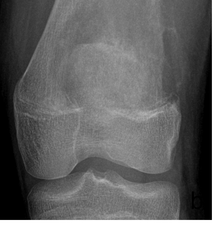 Tumor Bone Lesion 9b