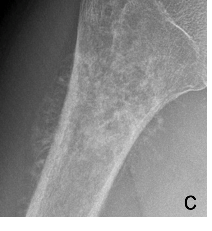 Tumor Bone Lesion 9c