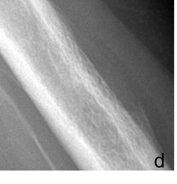 Tumor Bone Lesion 9d