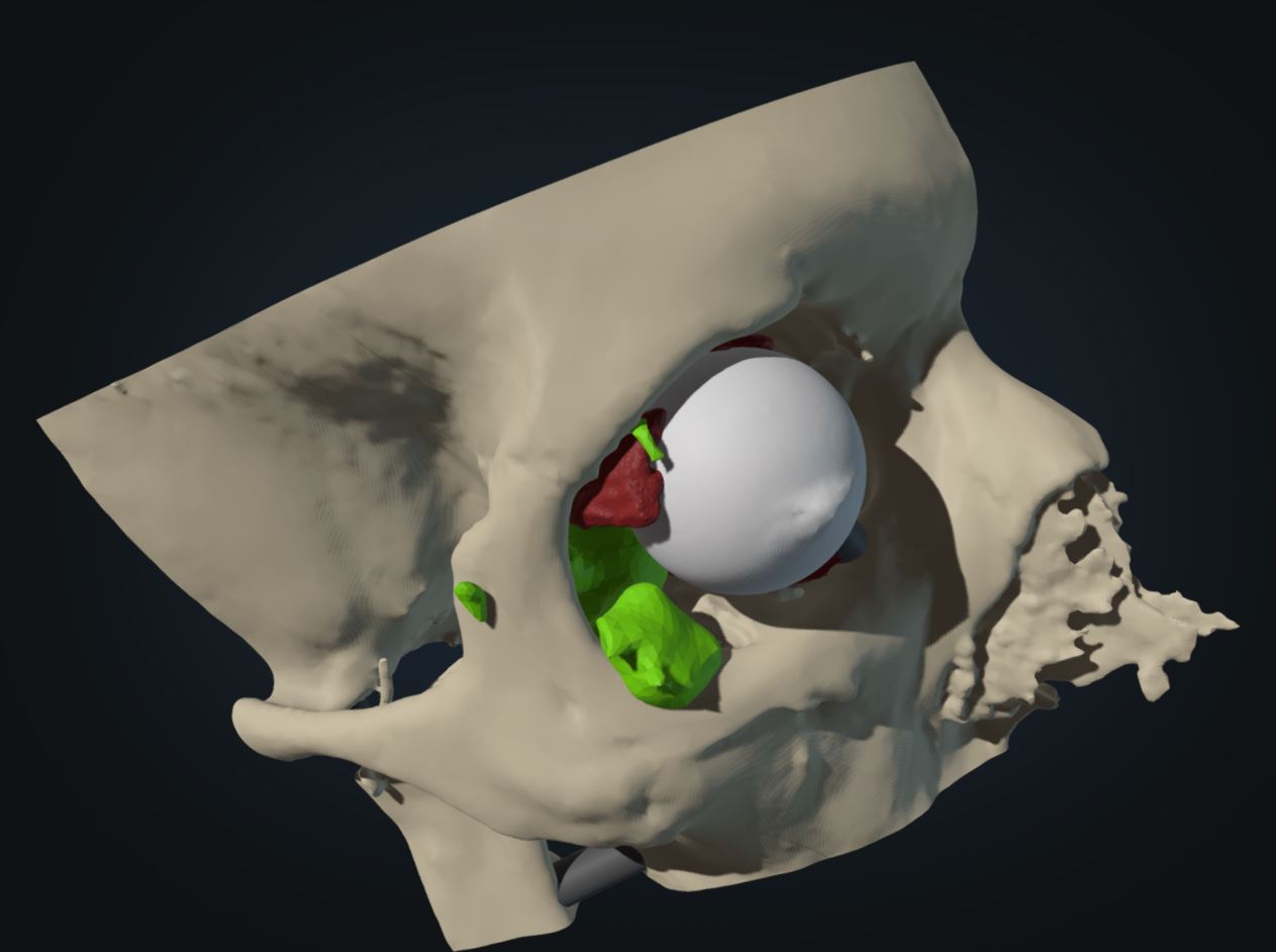 fused tumor virtual model