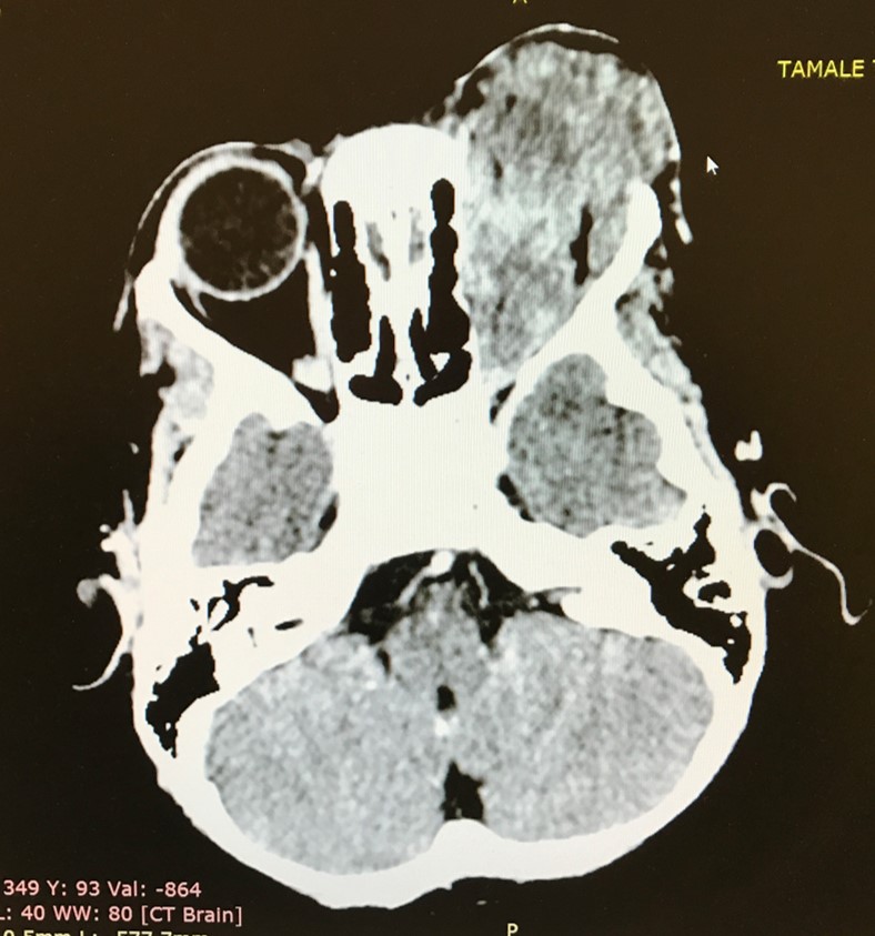 retinoblastoma