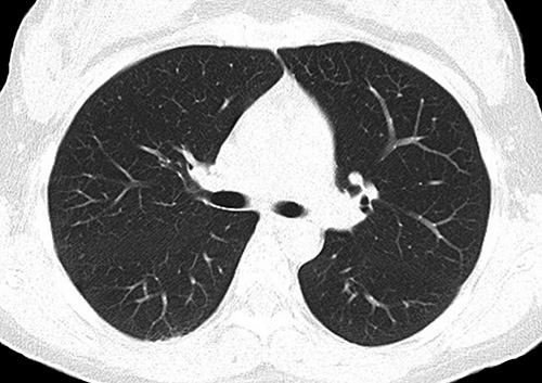 lung ct
