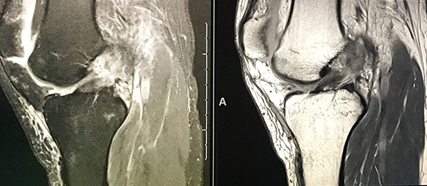 mri-acl-header.jpg