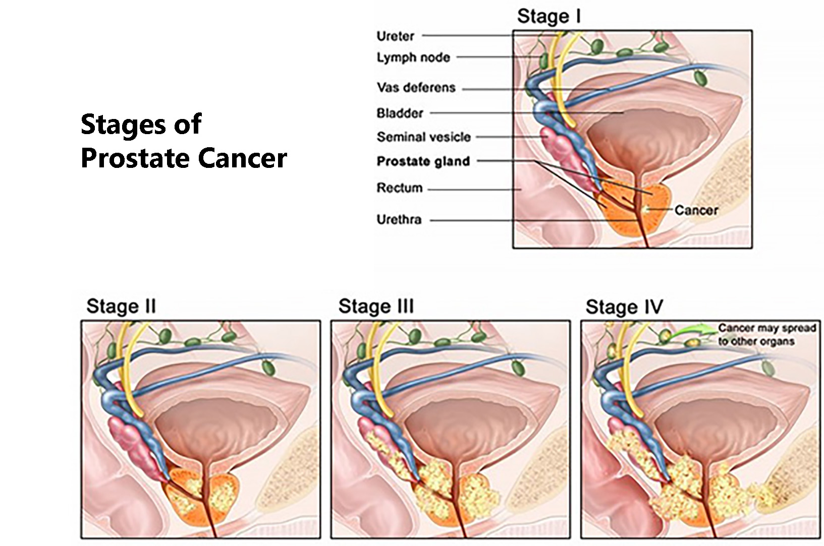 stages of prostate cancer