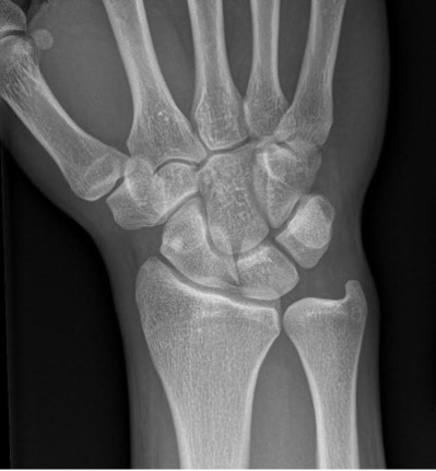 Traumatic Wrist Injury