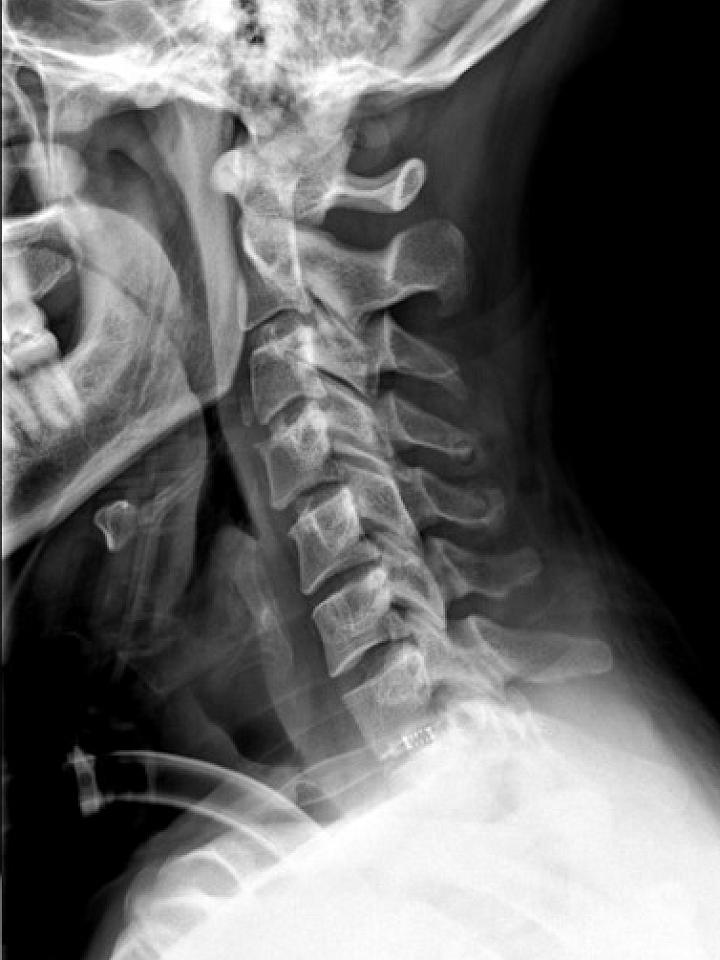 cervical spine trauma