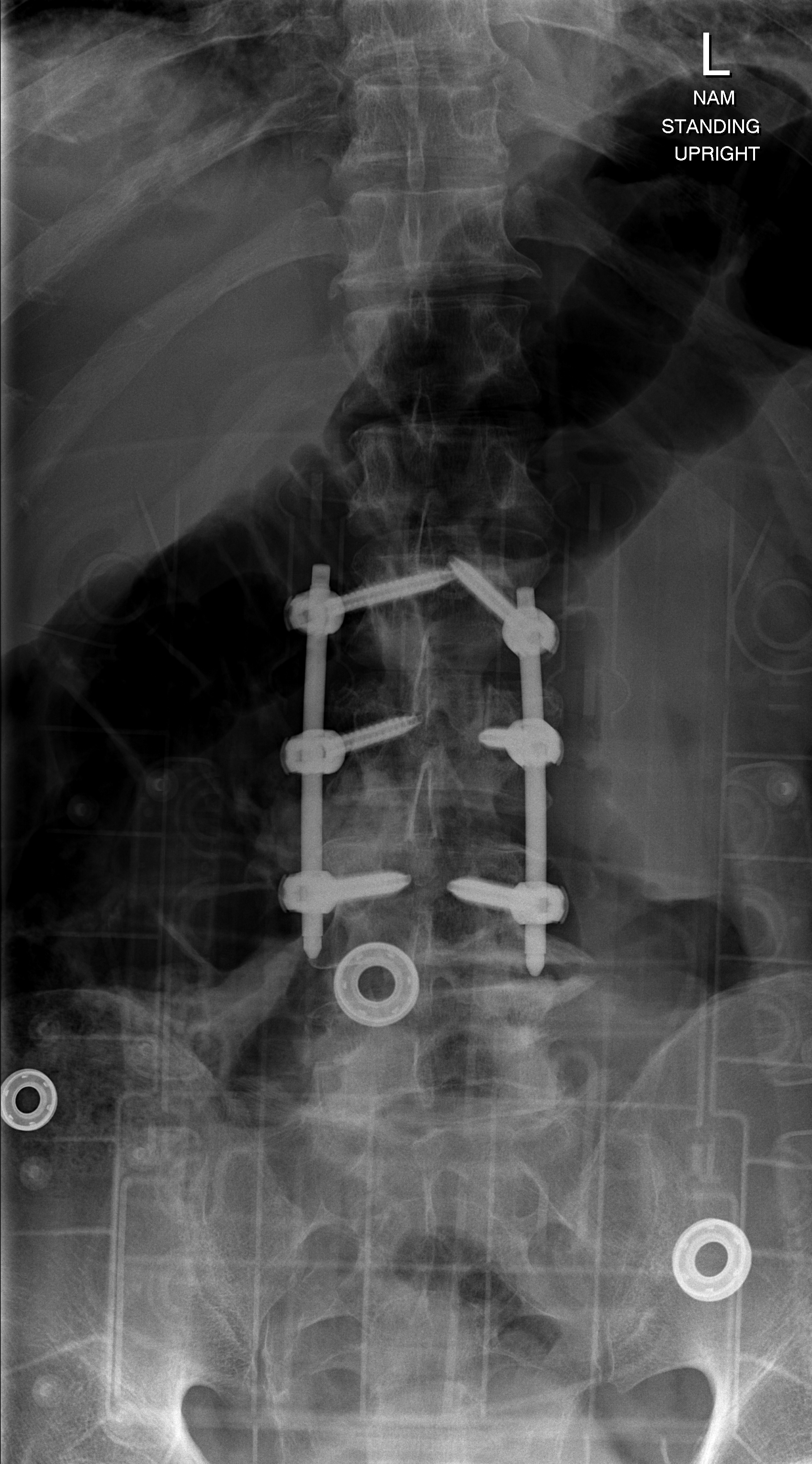 Spine Xray Image