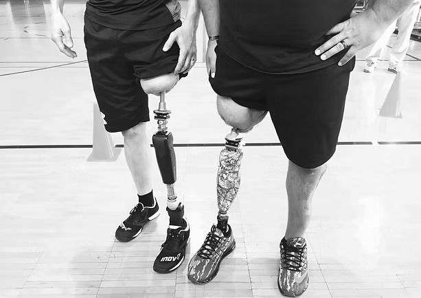 amputee patient